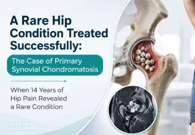 A Rare Hip Condition Treated Successfully: The Case of Primary Synovial Chondromatosis